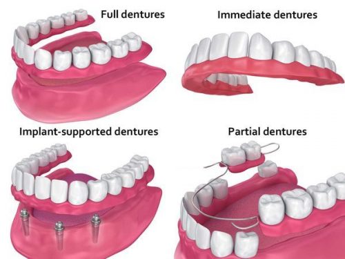 Dental Implants In Fort Walton Beach, Fl