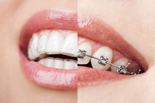 8 Tips for Adjusting to Invisalign Braces