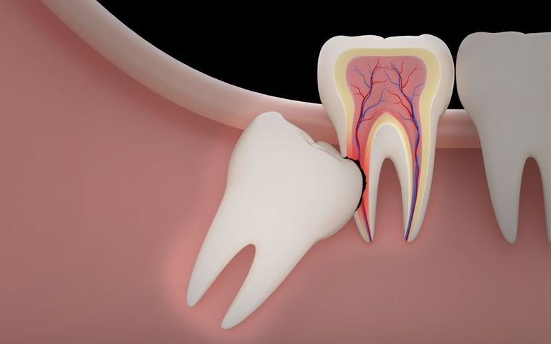 Affordable Wisdom Tooth Extractions | Emergency Wisdom Tooth Extractions in  Michigan | Dearborn, MI Wisdom Tooth Extractions | Sachs Family Dentistry